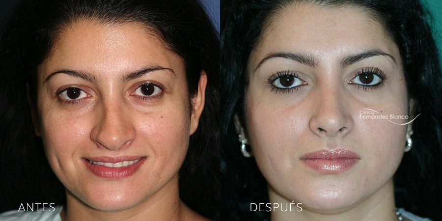 rinoplastia fotos antes y despues, cirugía de nariz, Madrid y Marbella, clínica Fernández Blanco