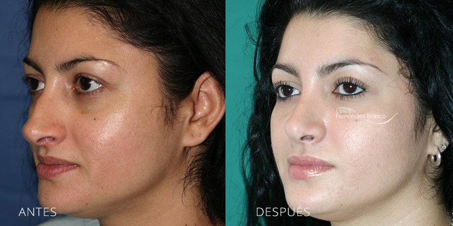 rinoplastia fotos antes y despues, cirugía de nariz, Madrid y Marbella, clínica Fernández Blanco, vista de medio perfil