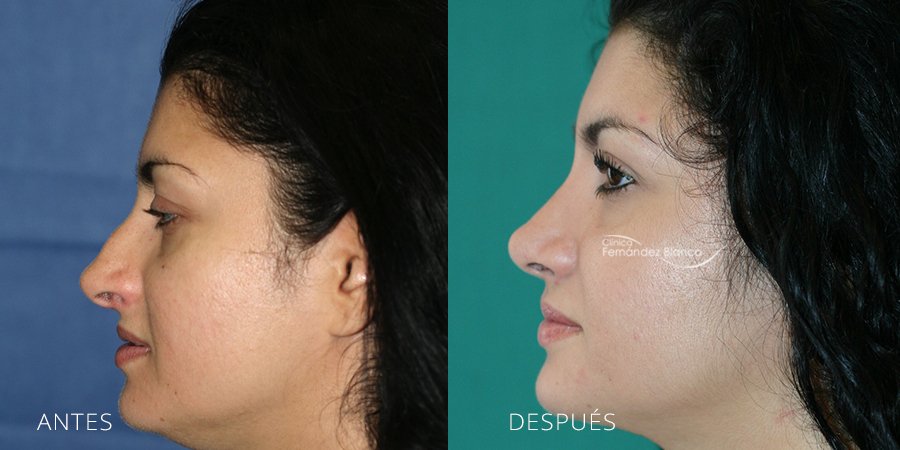 rinoplastia fotos antes y despues, cirugía de nariz, Madrid y Marbella, clínica Fernández Blanco, vista de perfil