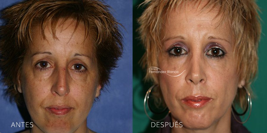 rinoplastia antes despues, operación nariz, casos reales, rinoplastia en marbella, clínica Fernández Blanco