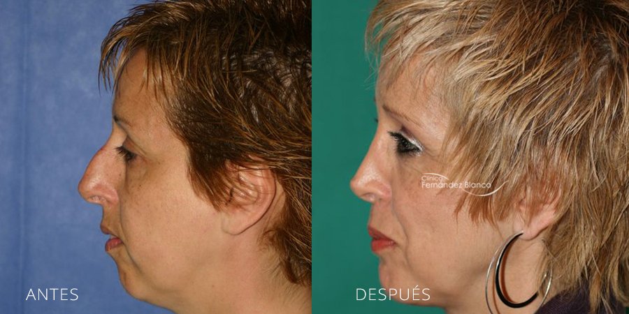 rinoplastia antes despues, operación nariz, casos reales, rinoplastia en marbella, clínica Fernández Blanco, vista de perfil