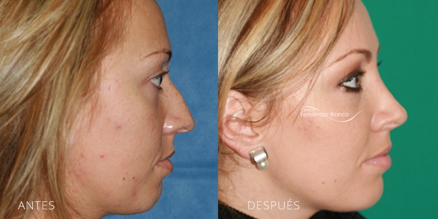 Rinoplastia operación nariz, rinoplastia fotos antes y despues, rinoplastia en madrid, paciente del cirujano plastico Dr Fernández Blanco, vista de medio perfil