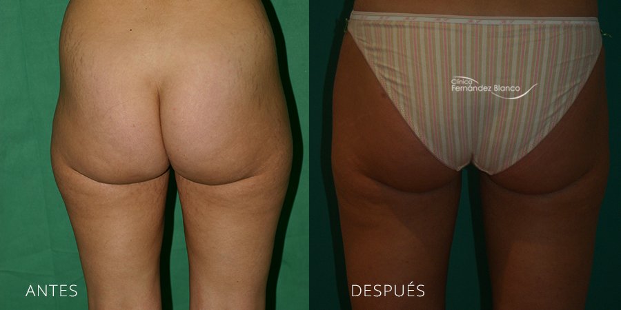 Antes y después de una Abdomen liposucción en Marbella
