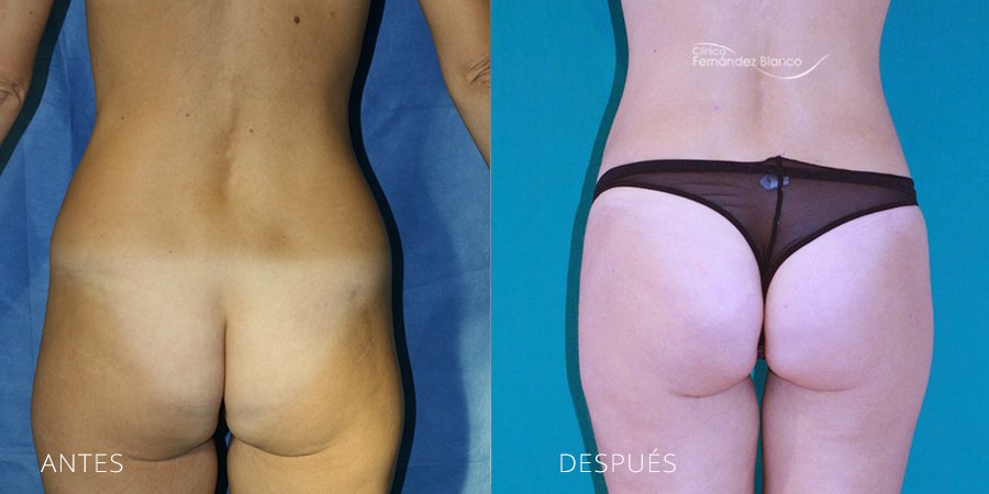 Vista trasera del antes y después liposucción con armonización corporal en cintura,