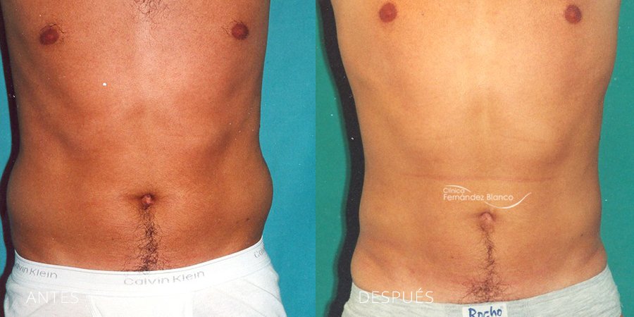 Liposucción de abdomen en Marbella