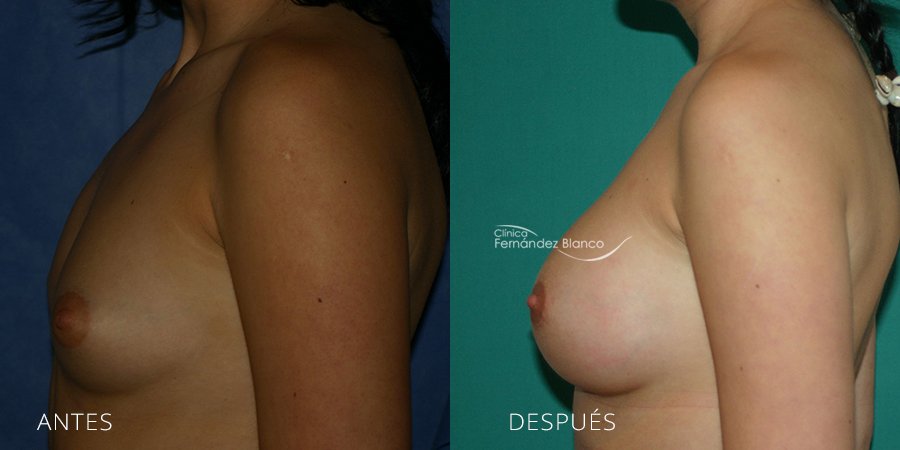 Surgery asymmetry mammary Case 1