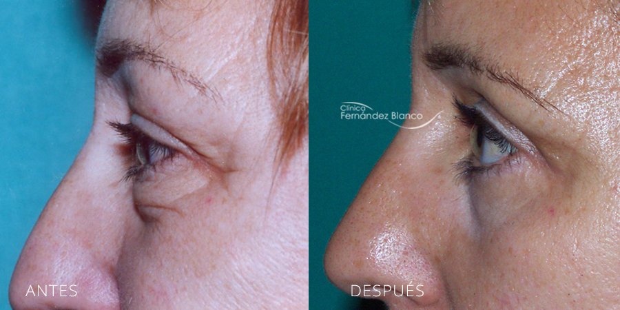 Eyelids – Blepharoplasty Case 2