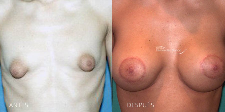 Tuberous breast Case 1