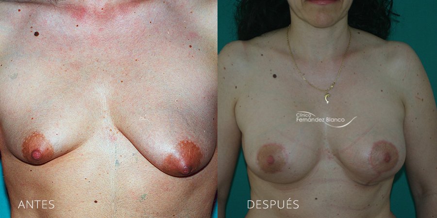 Tuberous breast Case 2
