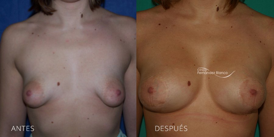 Tuberous breast Case 3