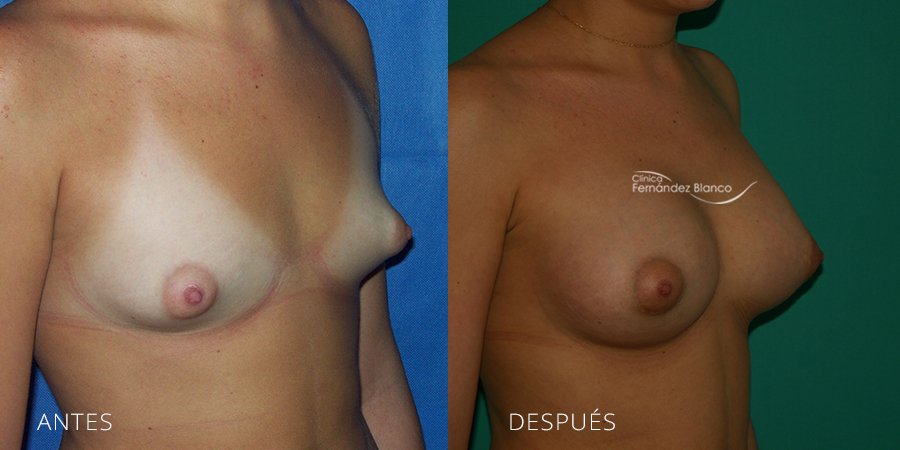 Tuberous breast Case 4