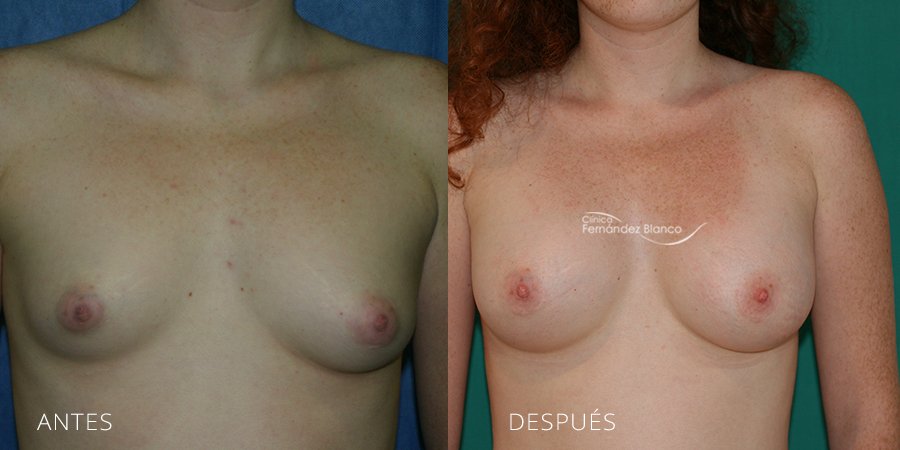 Tuberous breast Case 5