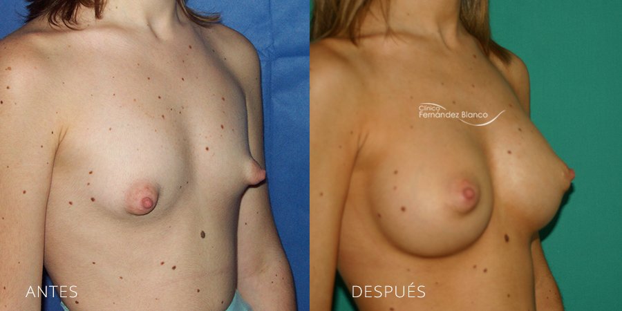 Tuberous breast Case 6