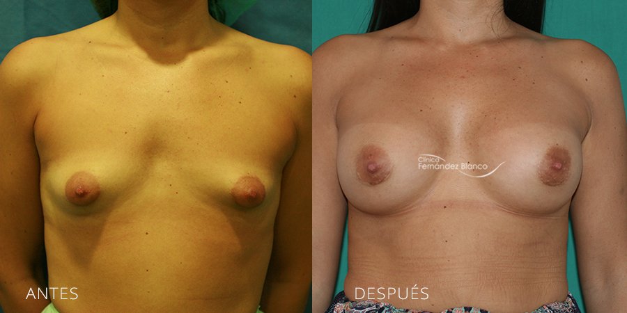 Tuberous breast Case 7