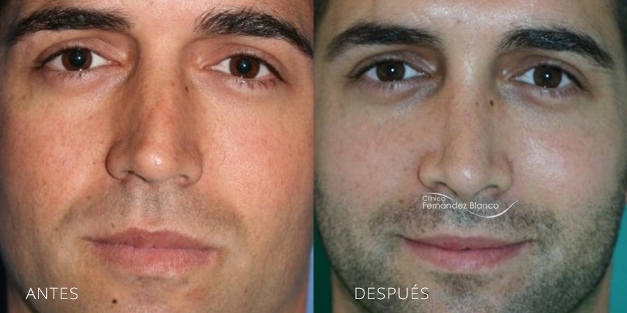 Rinoplastia procedimiento caballero, casos reales, fotos de antes y después, rinoplastia  en clínica Marbella