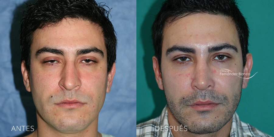 operación nariz, antes y despues, rinoplastia recuperación, clinica plástico Dr Fernández Blanco en madrid