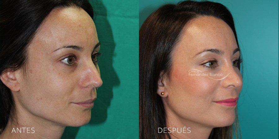 Rinoplastia resultados, fotos de antes y despues, casos reales, operacion de nariz en marbella, paciente del cirujano plástico Dr Fernández Blanco