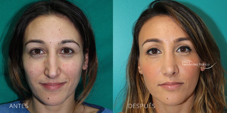 rinoplastia madrid, cirugía de nariz, fotos de antes y después, paciente del cirujano plástico Dr Fernández Blanco