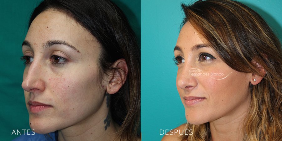 rinoplastia marbella, cirugía de nariz, fotos de antes y después, paciente del cirujano plástico Dr Fernández Blanco, vista de medio perfil