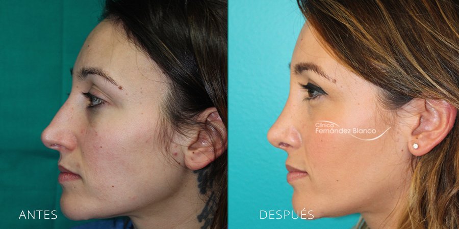 rinoplastia marbella, cirugía de nariz, fotos de antes y después, paciente del cirujano plástico Dr Fernández Blanco, vista de perfil