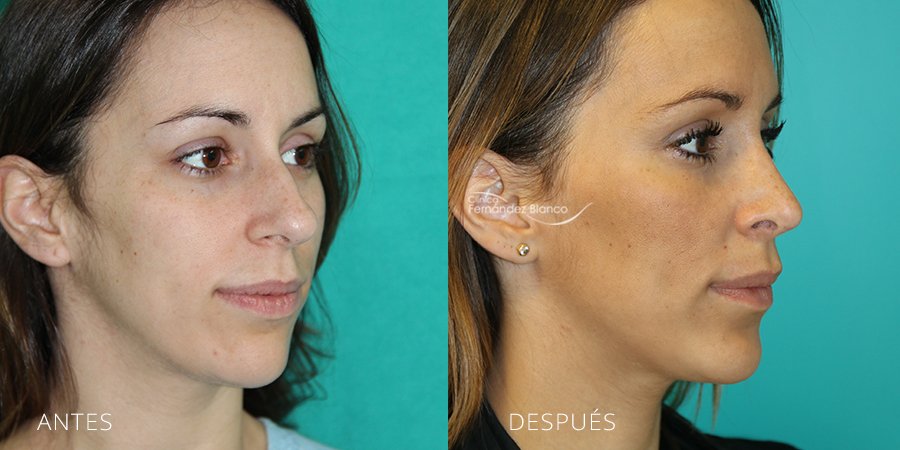 operación nariz, antes y despues, rinoplastia recuperación, clinica plástico Dr Fernández Blanco en marbella, vista de medio perfil