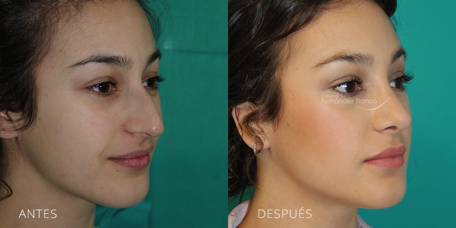 cirugía de nariz Madrid, , fotos de antes y despues, casos reales, paciente del cirujano plastico Dr Fernández Blanco