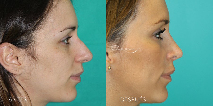 operación nariz, antes y despues, rinoplastia recuperación, clinica plástico Dr Fernández Blanco en marbella, vista de perfil