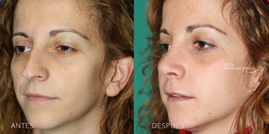 rinoplastia fotos antes y despues, rinoplastia madrid, operación nariz, clinica Fernández Blanco, vista de medio perfil