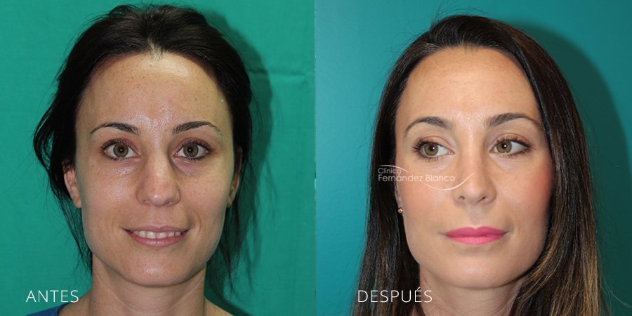 Rinoplastia resultados, fotos de antes y despues, casos reales, operacion de nariz en marbella, clinica Dr Fernández Blanco