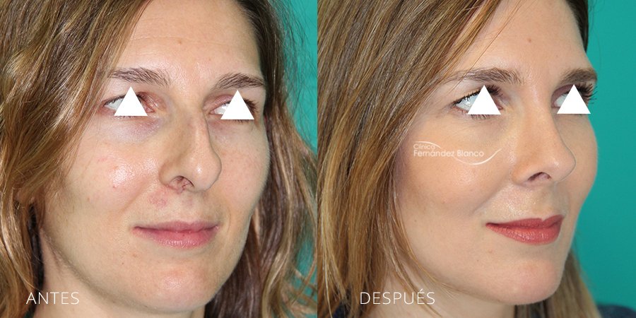 septoplastia, fotos antes y despues, rinoplastia en Marbella, paciente del cirujano plastico Dr Fernández Blanco, vista de medio perfil