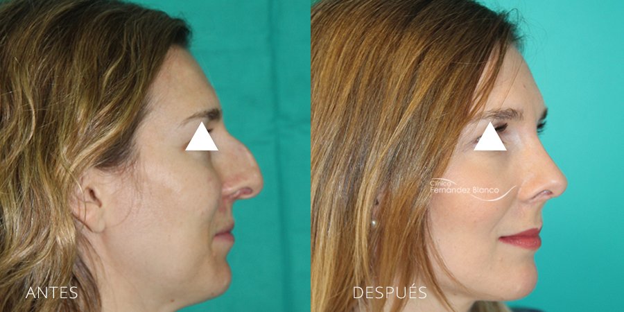 septoplastia, fotos antes y despues, rinoplastia, paciente del cirujano plastico Dr Fernández Blanco, vista de perfil