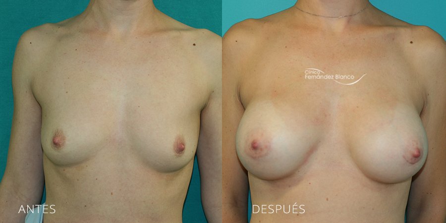 Breast augmentation Case 45