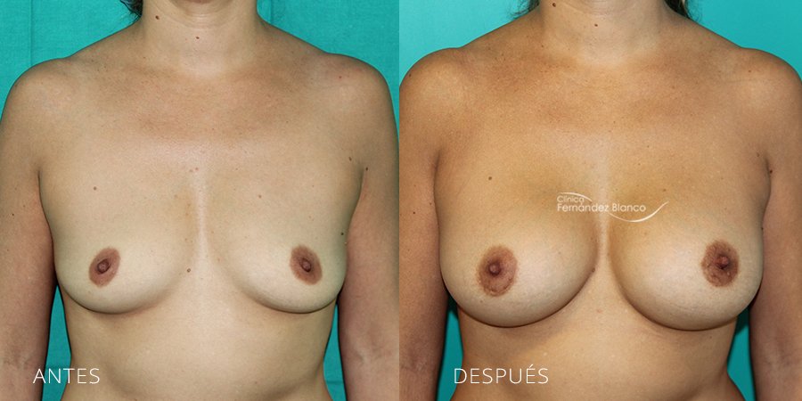 Breast augmentation Case 7