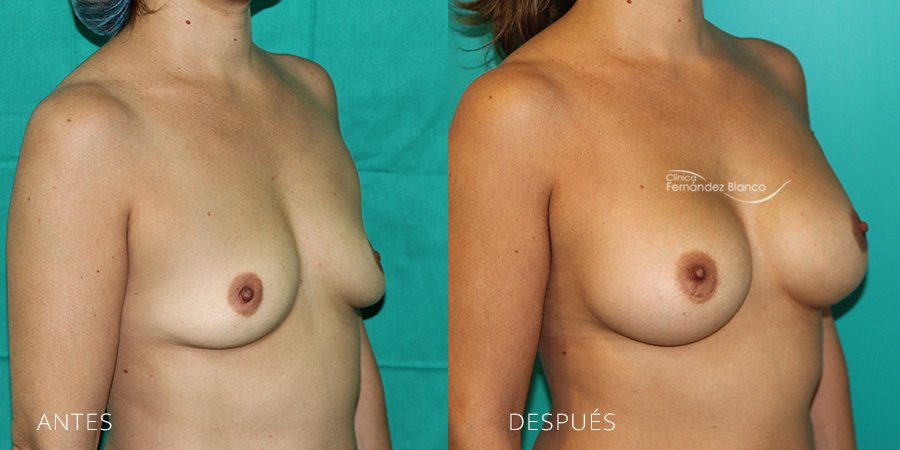 Vista perfil derecho del antes y después aumento de pecho con prótesis lisas de la marca SEBBIN, realizado en la Clínica FB