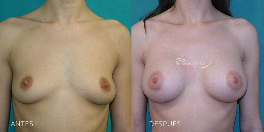 Breast augmentation Case 44