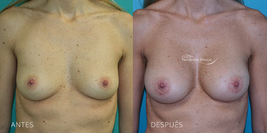 Breast augmentation Case 2