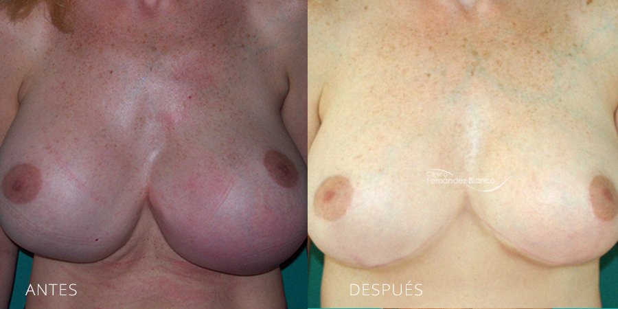 Antes y después mamoplastia Secundaria en Marbella. Cirugía realizada por el equipo de Clínica FB