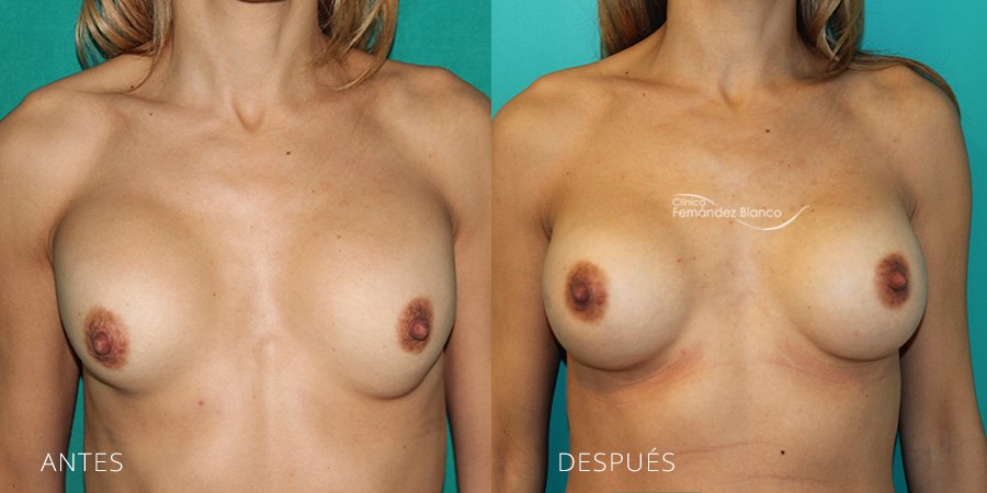 Secondary mammoplasties Case 5