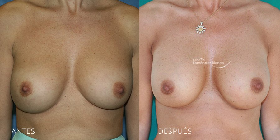 Secondary mammoplasties Case 2