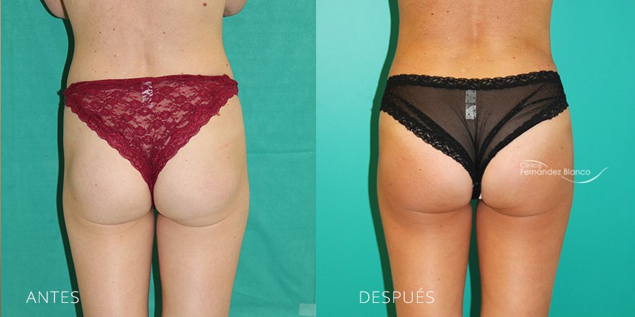 Gluteoplasties secondary or reparative Case 1