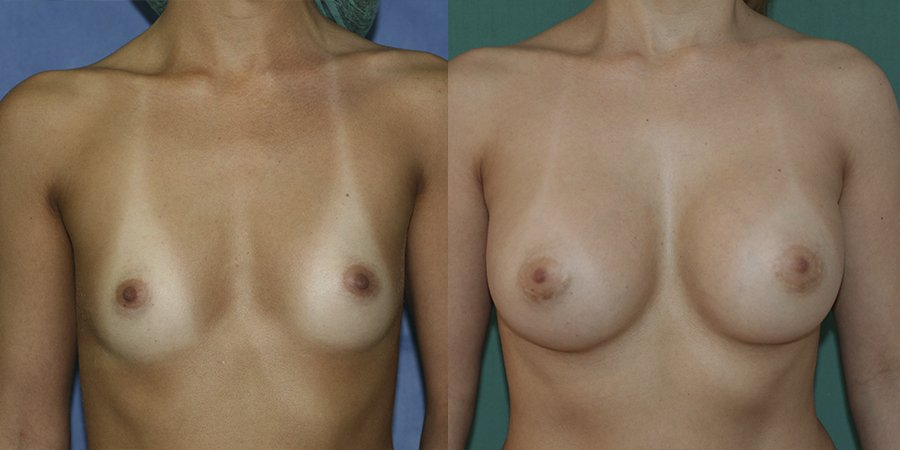 Breast augmentation Case 9