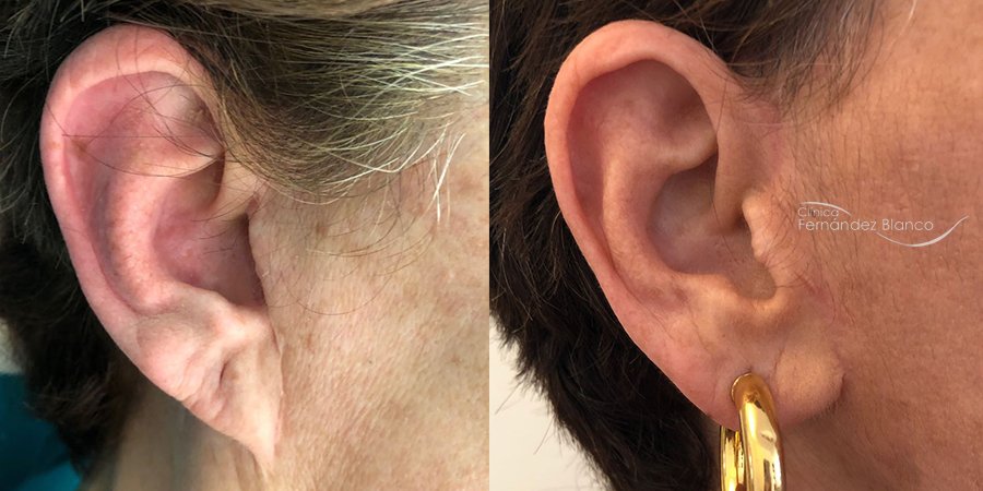 Surgery ear faun Case 1