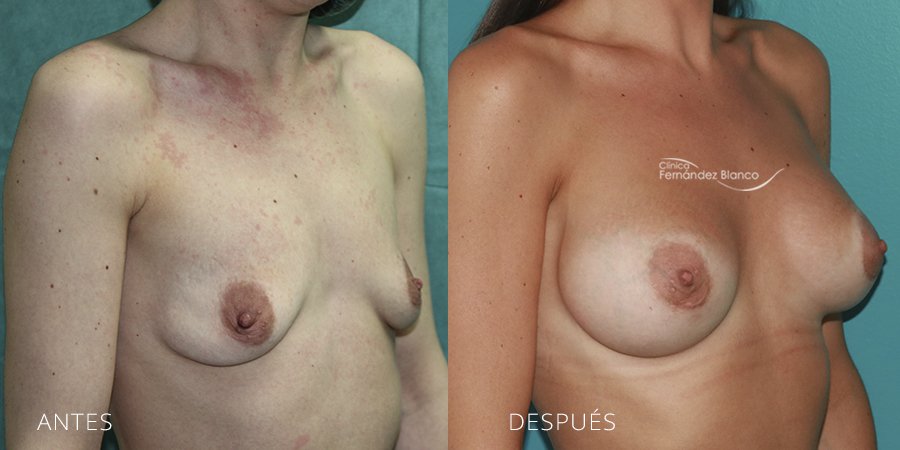 Breast augmentation Case 3