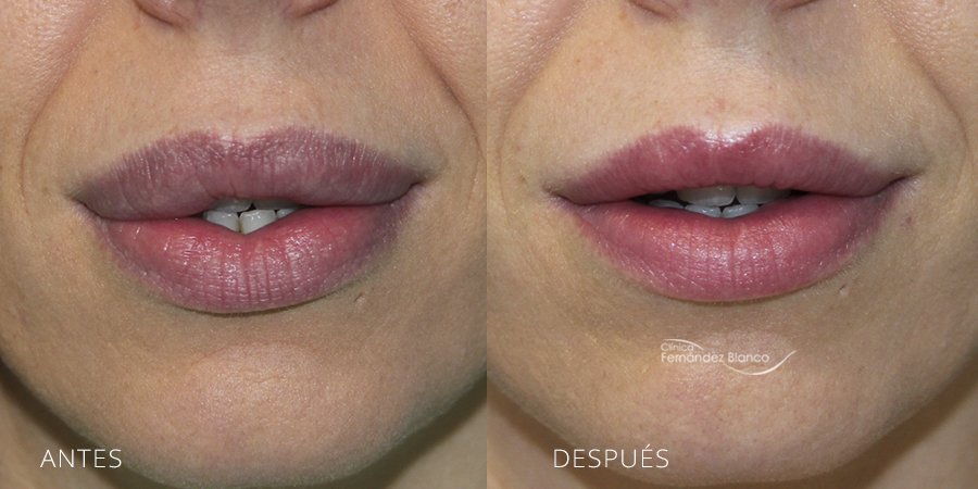 extracción de polimeros en labios, casos reales, fotos de antes y después, disminucion de labios, paciente del cirujano plástico Dr Fernández Blanco