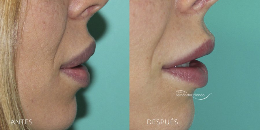 extracción de polimeros en labios, casos reales, fotos de antes y después, disminucion de labios, paciente del cirujano plástico Dr Fernández Blanco, vista de perfil
