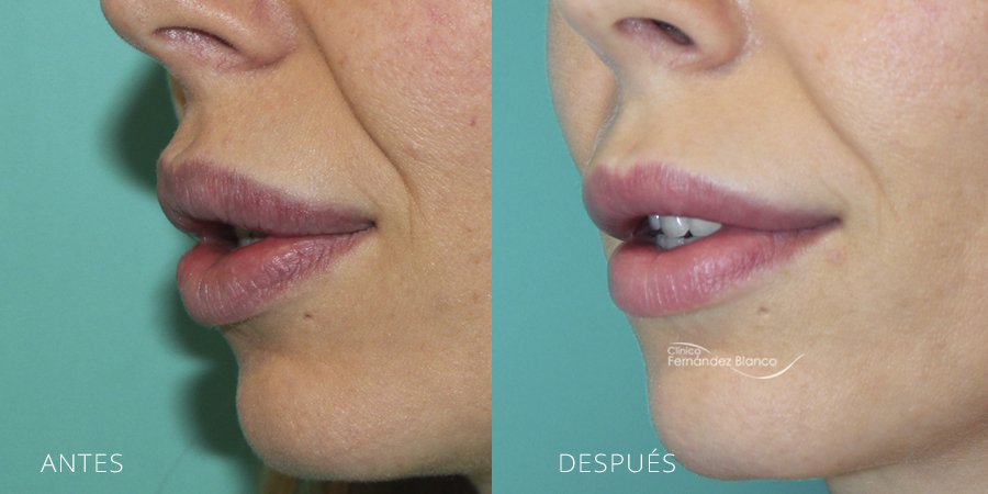 extracción de polimeros en labios, casos reales, fotos de antes y después, disminucion de labios, paciente del cirujano plástico Dr Fernández Blanco, vista de medio perfil