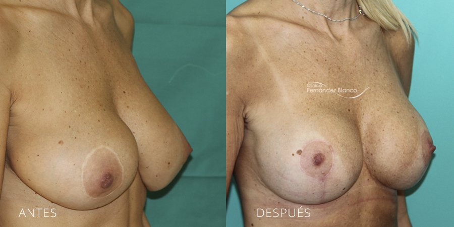 Secondary mammoplasties Case 8