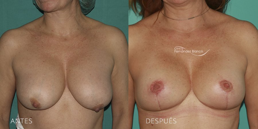 Secondary mammoplasties Case 9