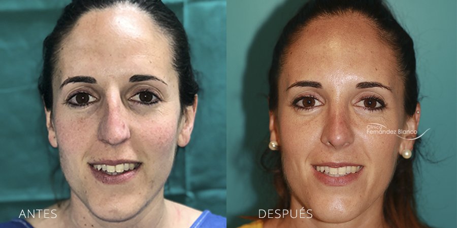 rinoseptoplastia, cirugía de nariz, rinoplastia en madrid, casos reales, paciente del dr Fernández Blanco