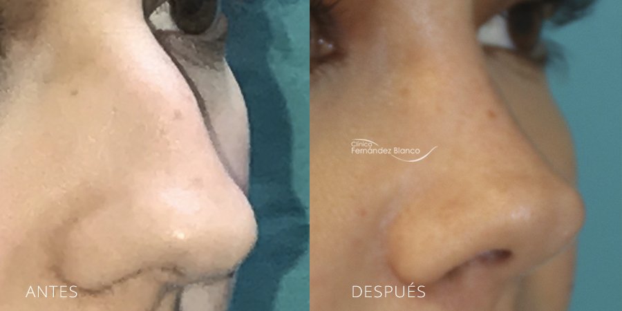 septumplastia, casos reales, rinoplastia madrid, antes y despues, paciente del dr Fernández Blanco, vista de medio perfil